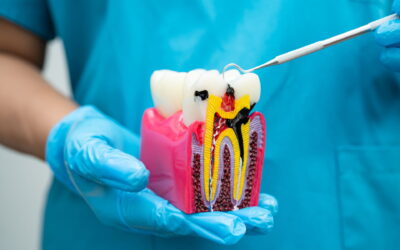 7 Signs That You Might Need a Root Canal